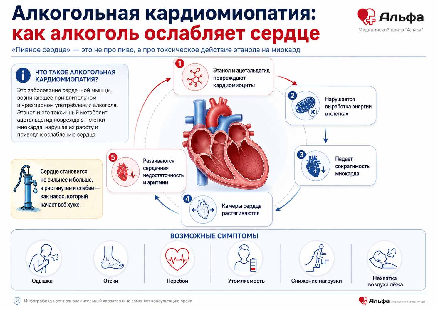 Инфографика о том, как алкоголь повреждает миокард и приводит к расширению камер сердца